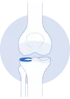 Meniscus Image