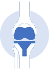 Total Knee Replacement