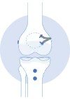 Patella Dislocation 1