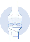Realignment Osteotomy